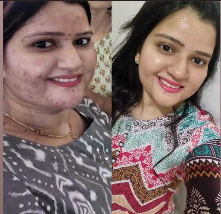 Acne treatment before and after results