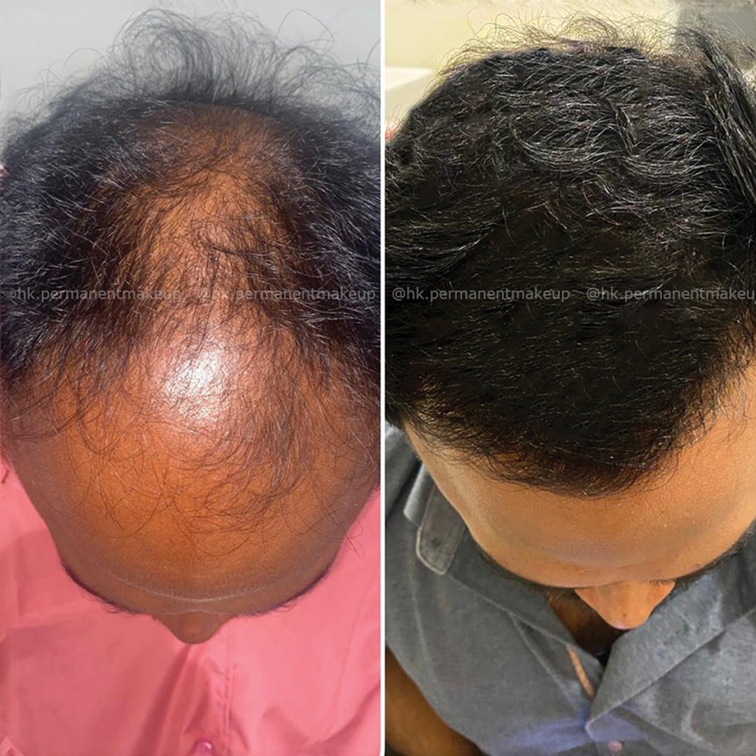Hair transplant before and after results